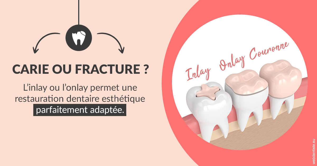 https://dr-acquaviva-cyril.chirurgiens-dentistes.fr/T2 2023 - Carie ou fracture 2