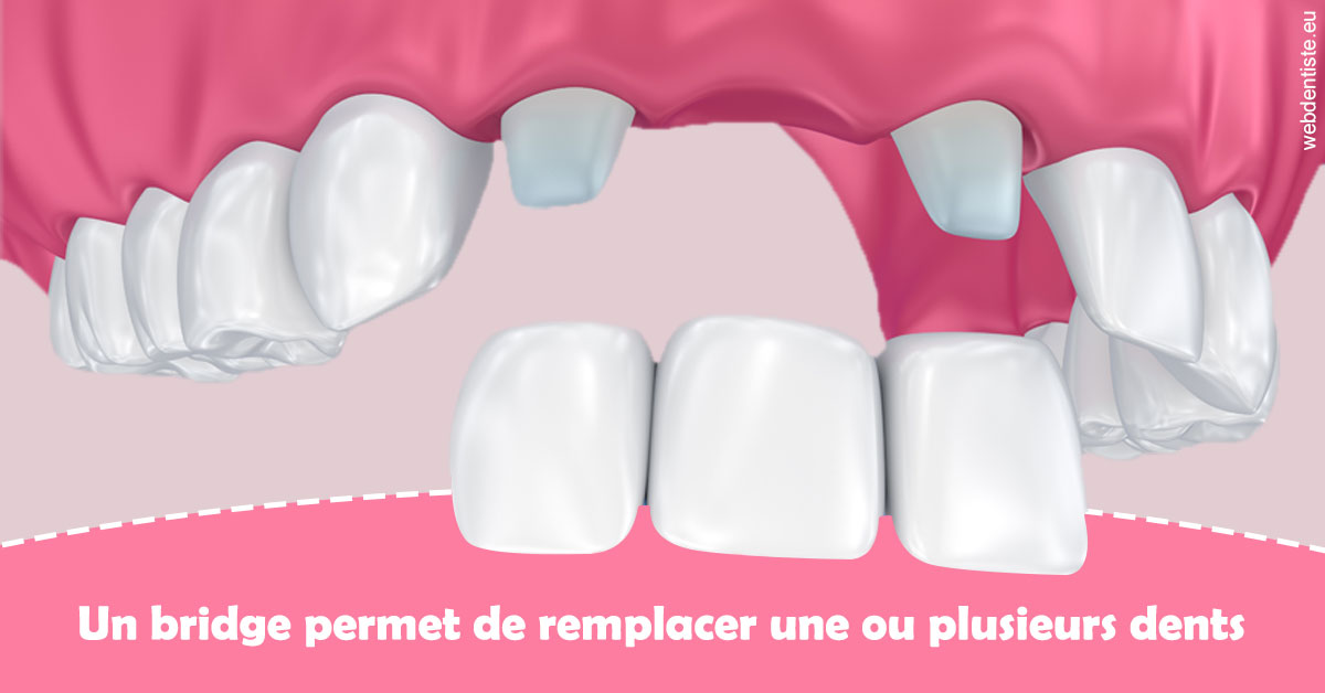 https://dr-acquaviva-cyril.chirurgiens-dentistes.fr/Bridge remplacer dents 2