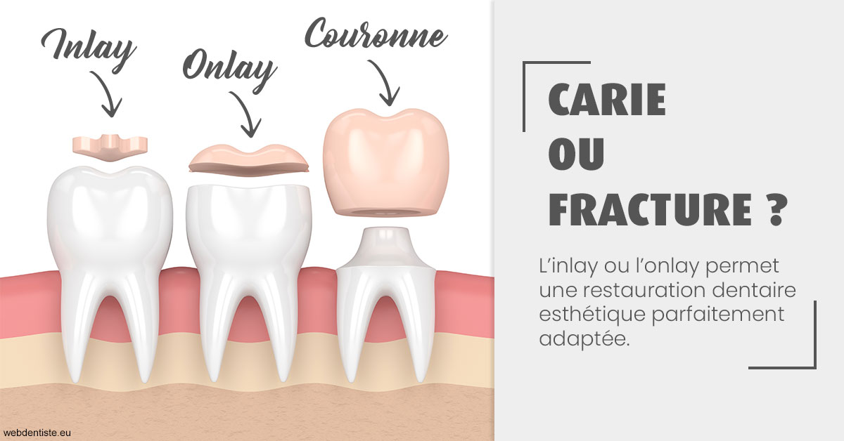 https://dr-acquaviva-cyril.chirurgiens-dentistes.fr/T2 2023 - Carie ou fracture 1
