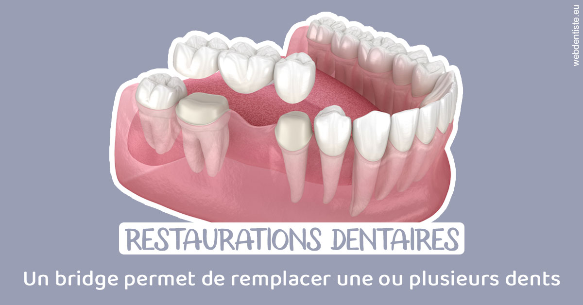 https://dr-acquaviva-cyril.chirurgiens-dentistes.fr/Bridge remplacer dents 1