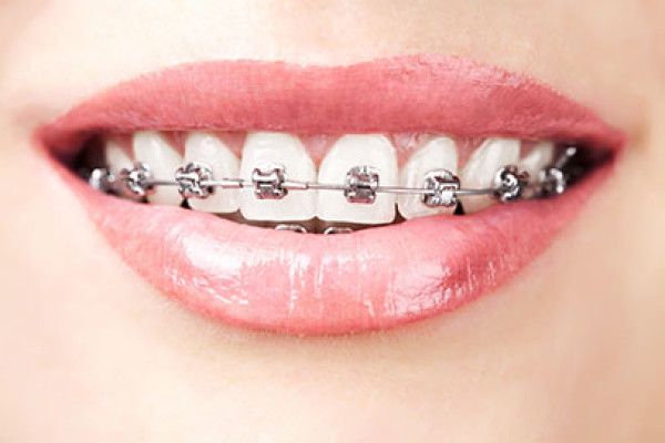 Collage des attaches (ou bagues, ou brackets) en orthodontie