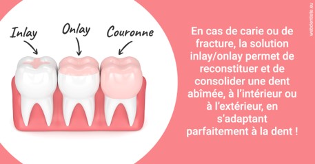 https://dr-acquaviva-cyril.chirurgiens-dentistes.fr/L'INLAY ou l'ONLAY 2