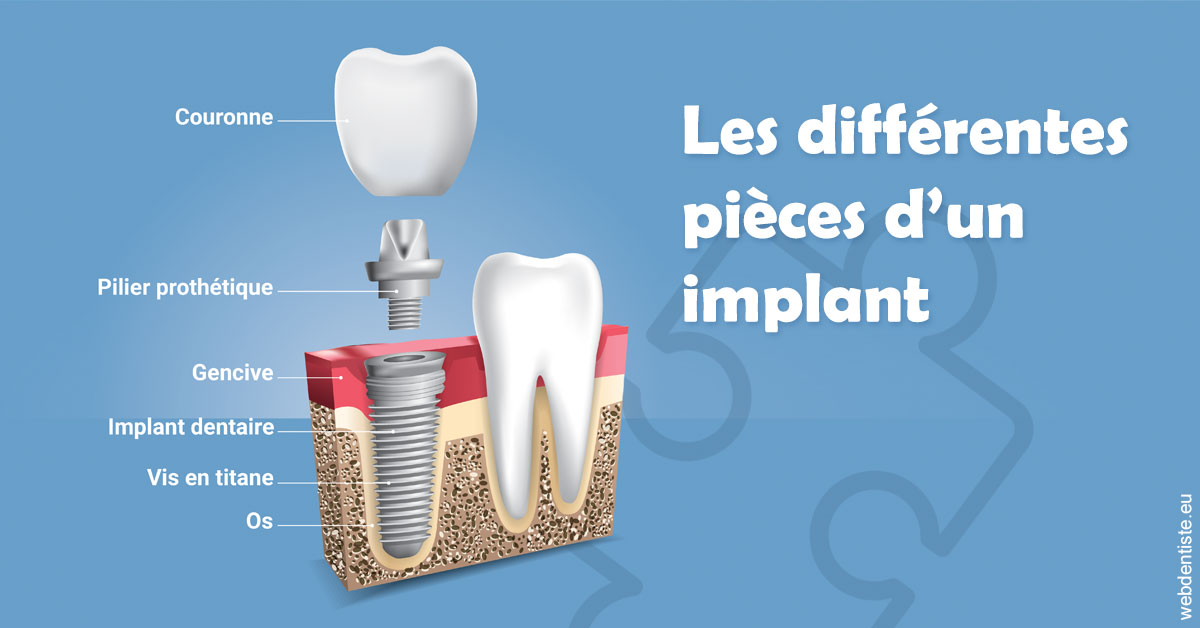 https://dr-acquaviva-cyril.chirurgiens-dentistes.fr/Les différentes pièces d’un implant 1